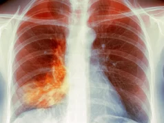 Q&A: ‘White Lung’ Pneumonia – What You Need to Know Q&A: ‘White Lung’ Pneumonia – What You Need to Know