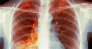 Q&A: ‘White Lung’ Pneumonia – What You Need to Know Q&A: ‘White Lung’ Pneumonia – What You Need to Know