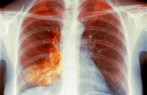 Q&A: ‘White Lung’ Pneumonia – What You Need to Know Q&A: ‘White Lung’ Pneumonia – What You Need to Know